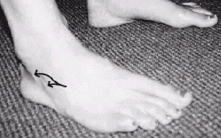 If there is a severe supination moment acting on the STJ you can observe