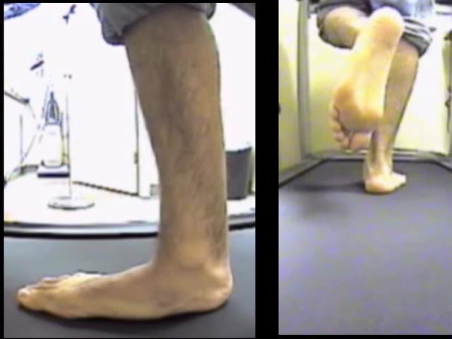 The single leg raise or tip toe test will quickly demonstrate if the