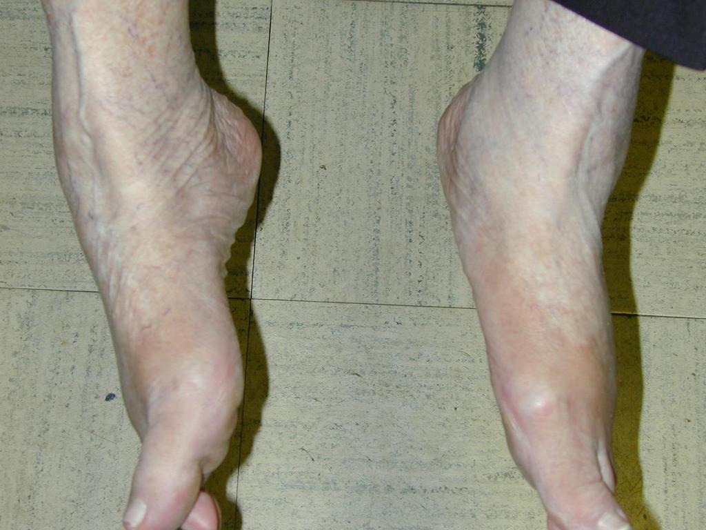The supination lag test is evaluated in the sitting position with the feet plantar flexed while the patient brings the soles of the foot together.