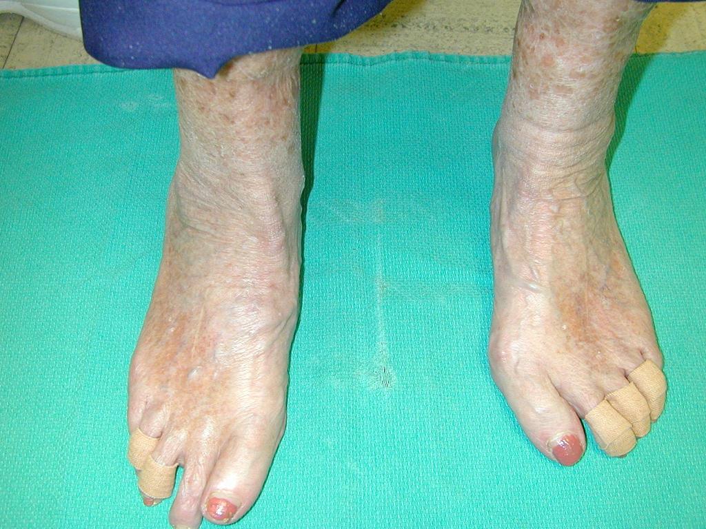 Greater pronation control will be required, if the feet you are evaluating are maximally pronated, difficult to resupinate, and
