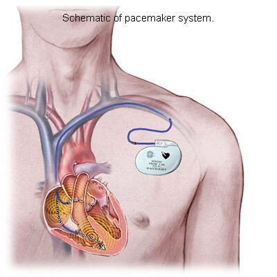 Artificial pacemakers restore proper