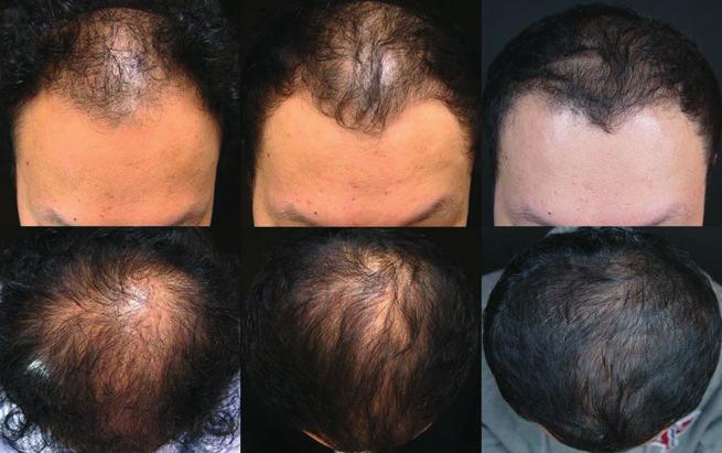 At baseline (A), post-finasteride treatment (B) and post-dutasteride treatment (C).