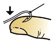 .Minor Wounds and Injuries 2 3 Step 2 Keep the affected body part flat and stable, then gently push down on the shank to free the barb from the injured tissue.