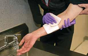 Treat thermal burns like this scalded forearm by running the affected area under cool running water, or by applying cool, wet compresses. Cover the area loosely with a sterile gauze pad and bandage.
