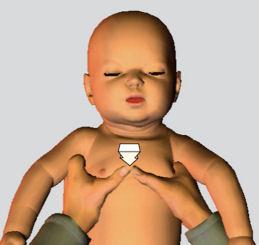 The most effective technique (as used by Australian NICU s and AHA) is the two-thumb technique Figure 6. In this method the thumbs are used over the sternum and the hands encircle the chest and back.